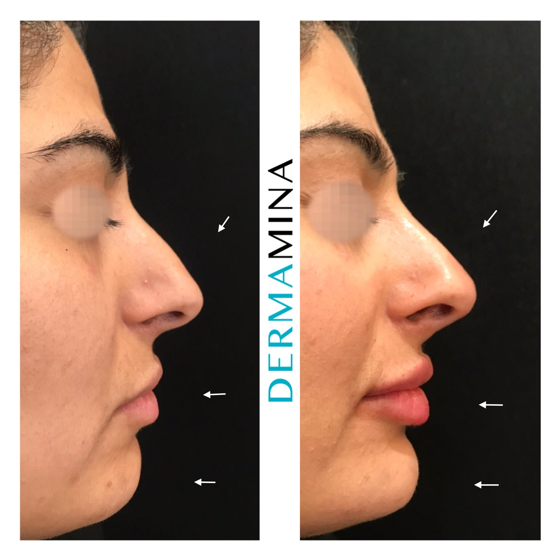 non surgical nose job before and after