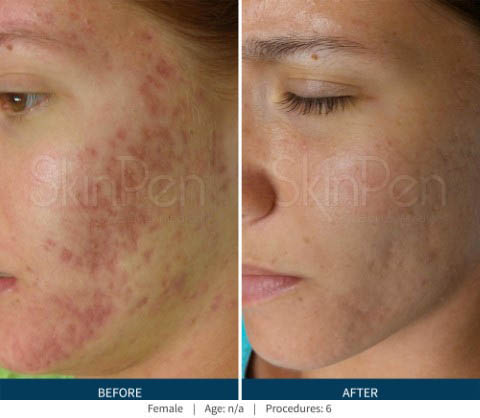 PRP Face Lift before and after