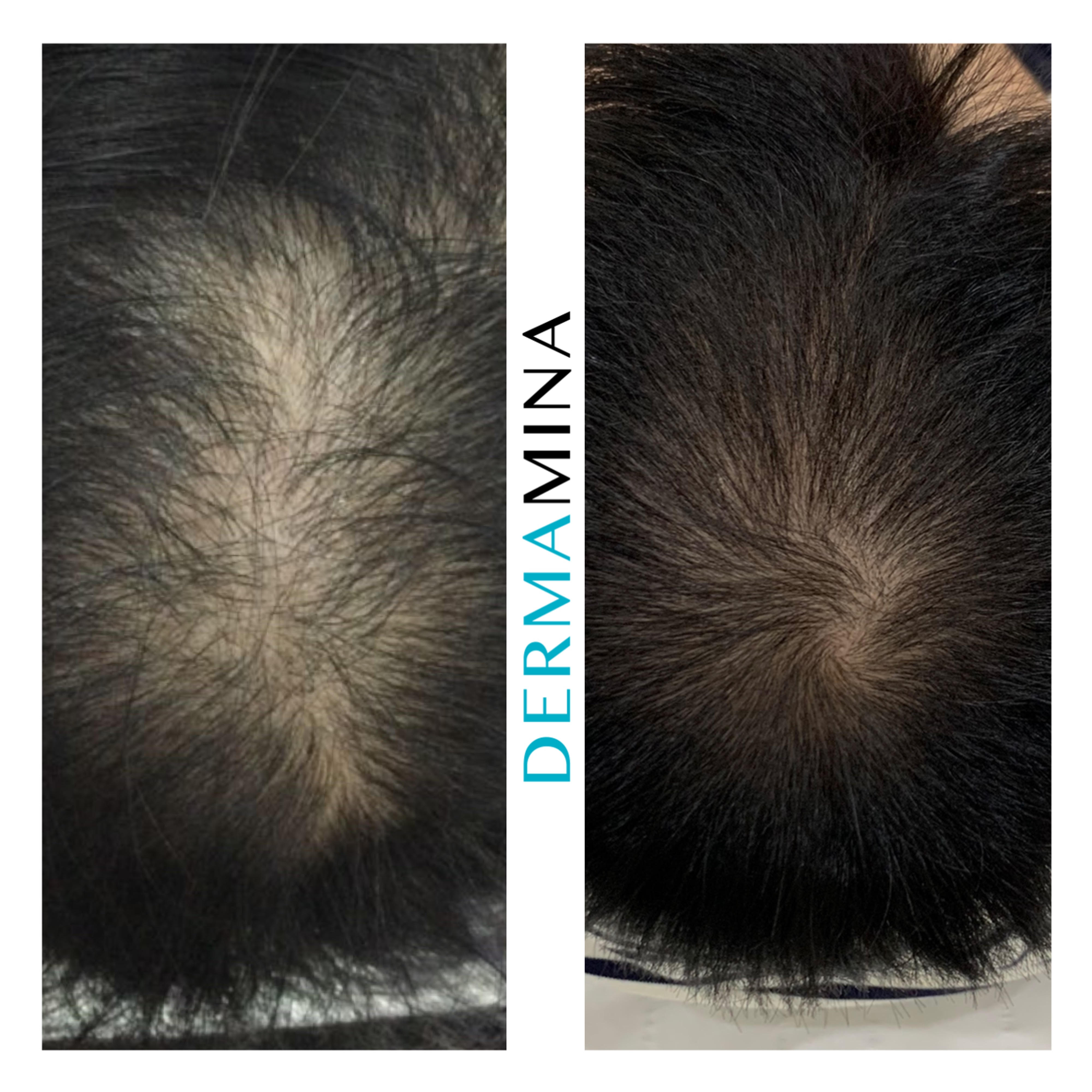 Hair Loss Treatment Before and After