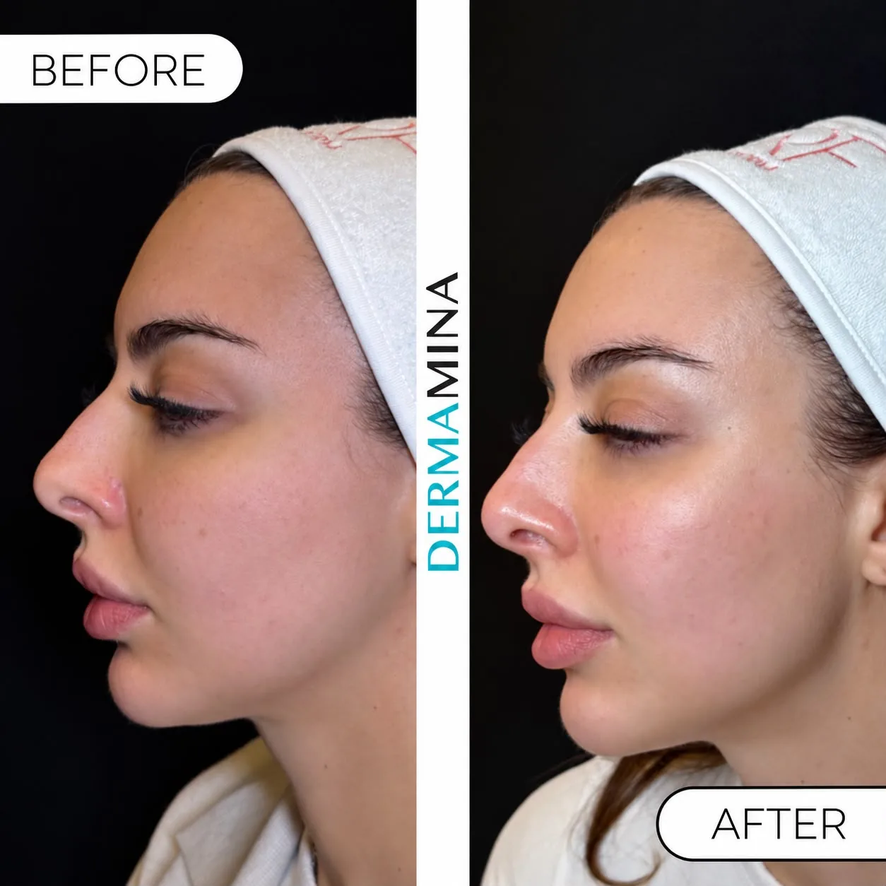 XERF before and after in profile on a Dermamina patient, firmer jawline and smoother lower face