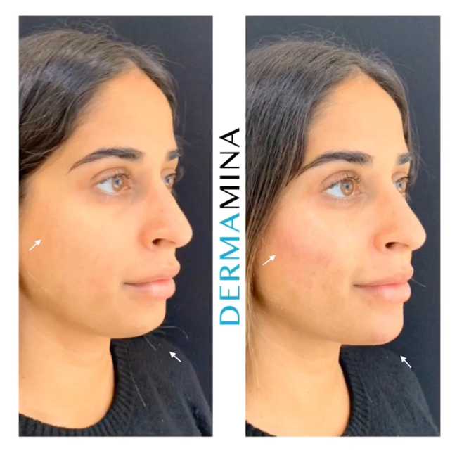 What Is The Cheek Filler Treatment And How Does It Work Dermamina