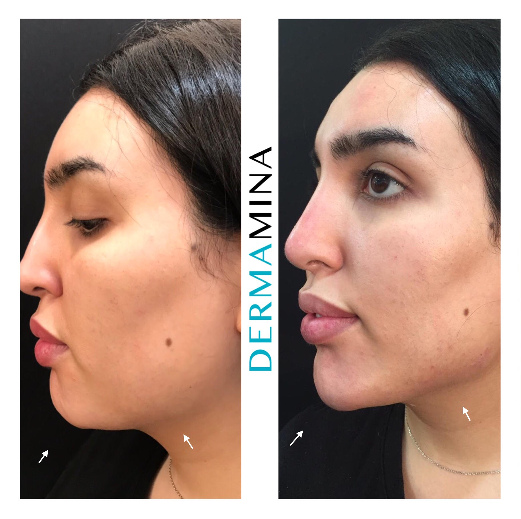 Non Surgical Nose Job London