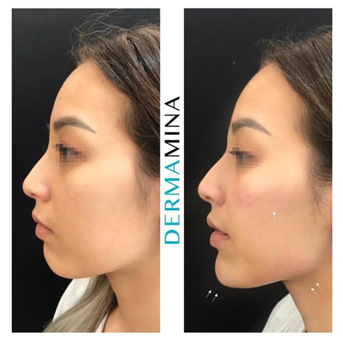 Non Surgical Nose Job London