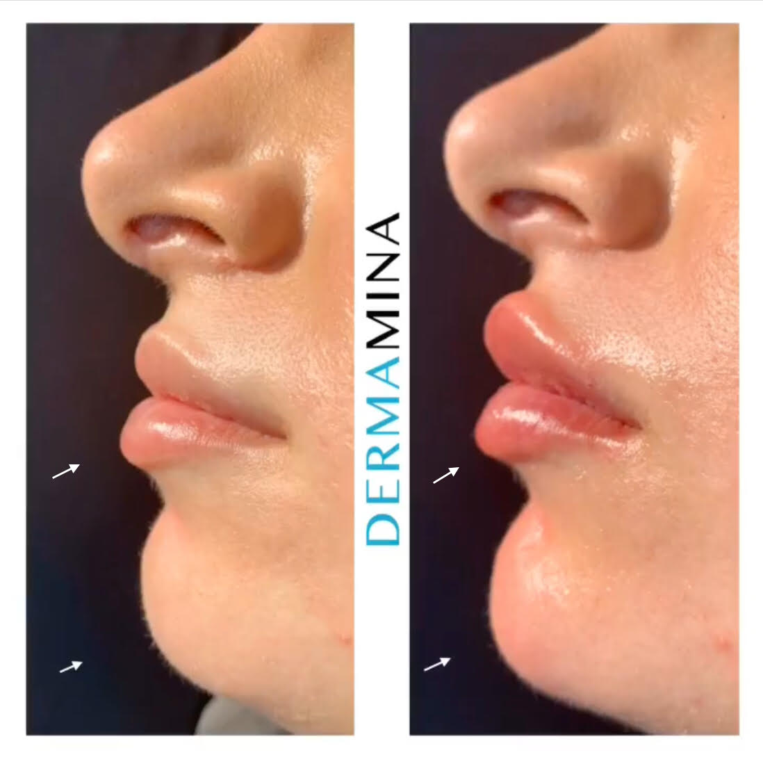 Non Surgical Nose Job London