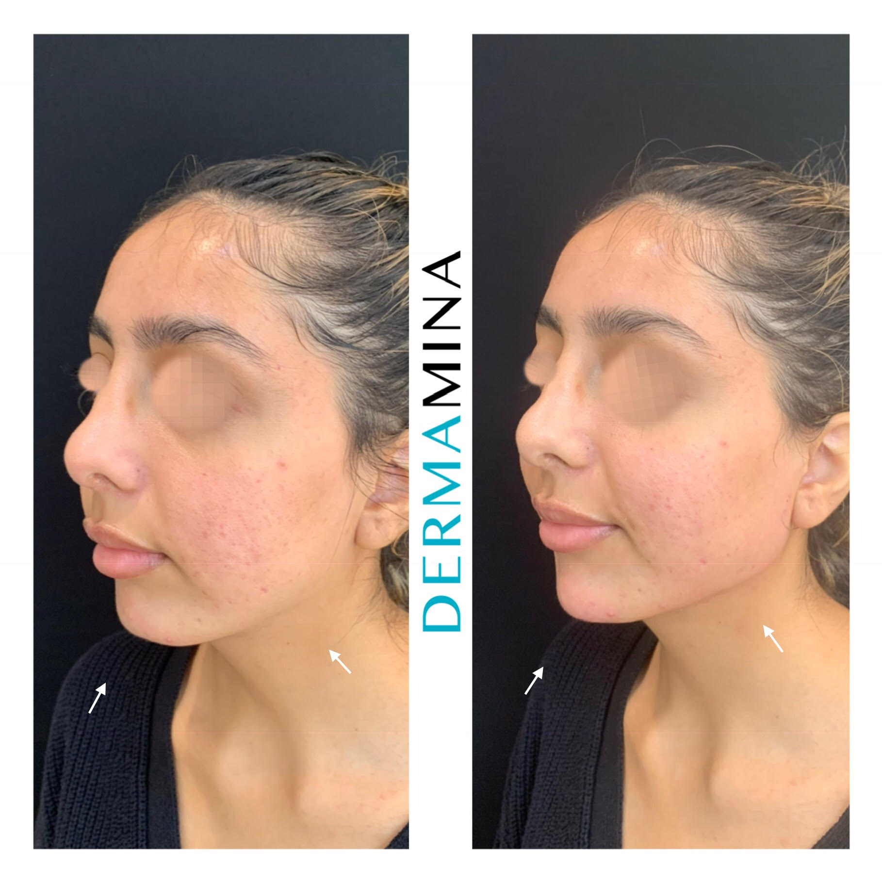 Non Surgical Nose Job London