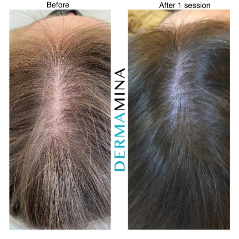 Hair Loss Treatment Before and After