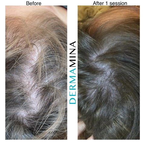 Hair Loss Treatment Before and After