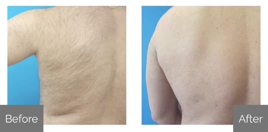 laser hair removal portland me