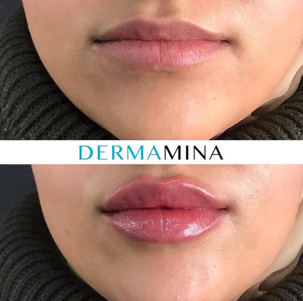 Lip enhancement london