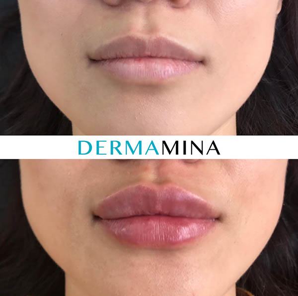 Lip enhancement london