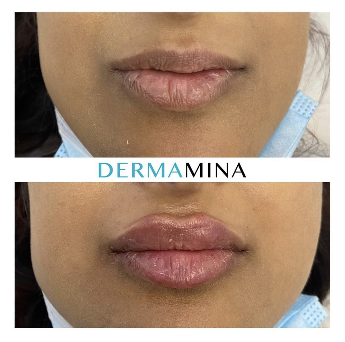 Lip enhancement london