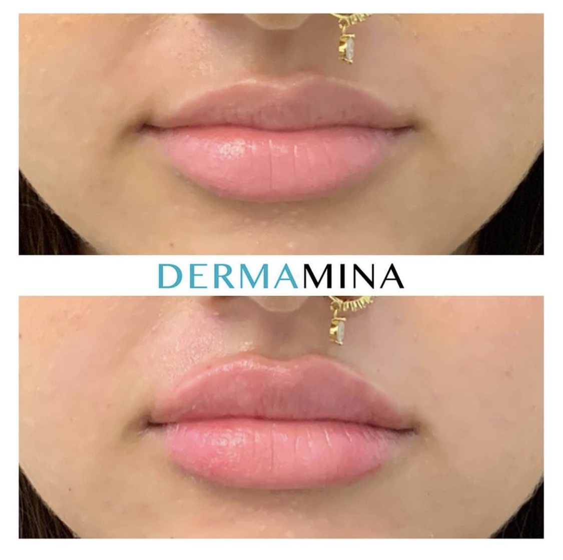 Lip enhancement london