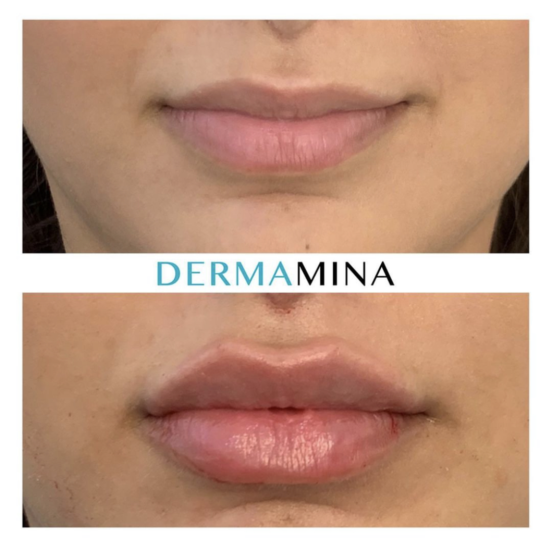 Lip enhancement london