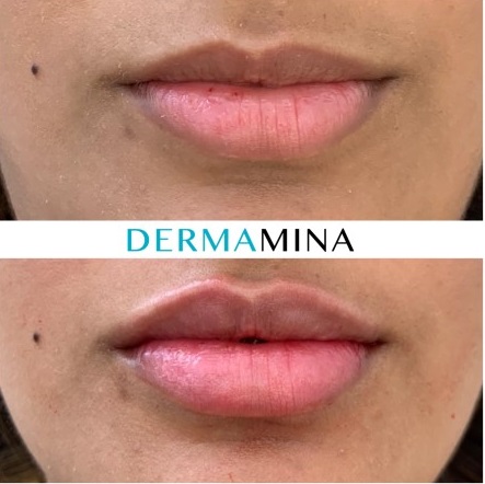 Lip enhancement london