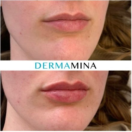 Lip enhancement london