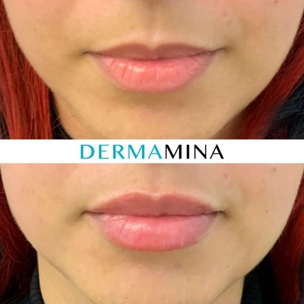 Lip enhancement london