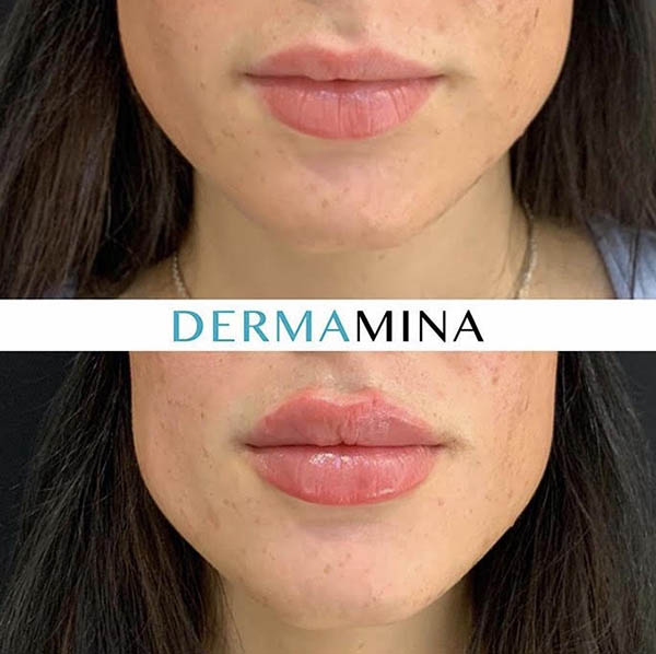 Lip enhancement london