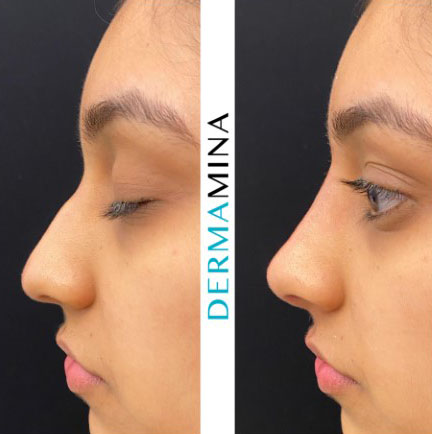 Non Surgical Nose Job London