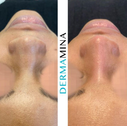 Non Surgical Nose Job London