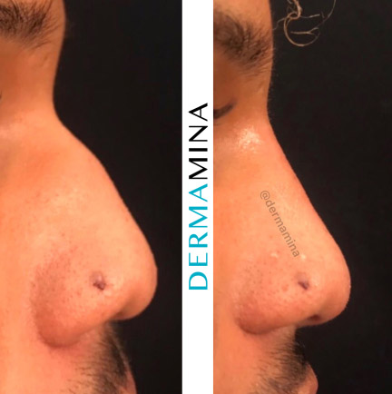 Non Surgical Nose Job London