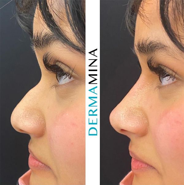 non surgical nose job before and after