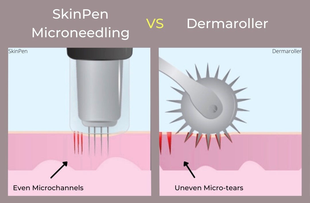 Microneedling SkinPen