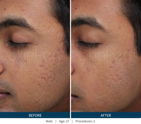 Non Surgical Nose Job London