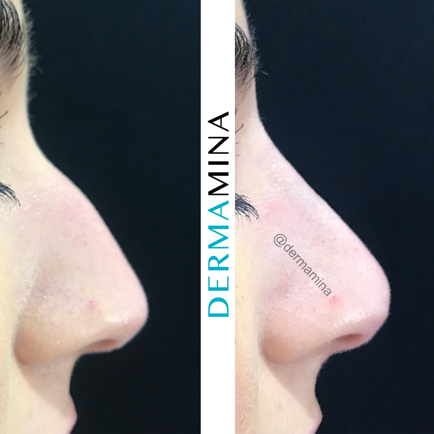 Non Surgical Nose Job London