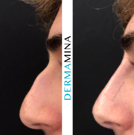 Non Surgical Nose Job London