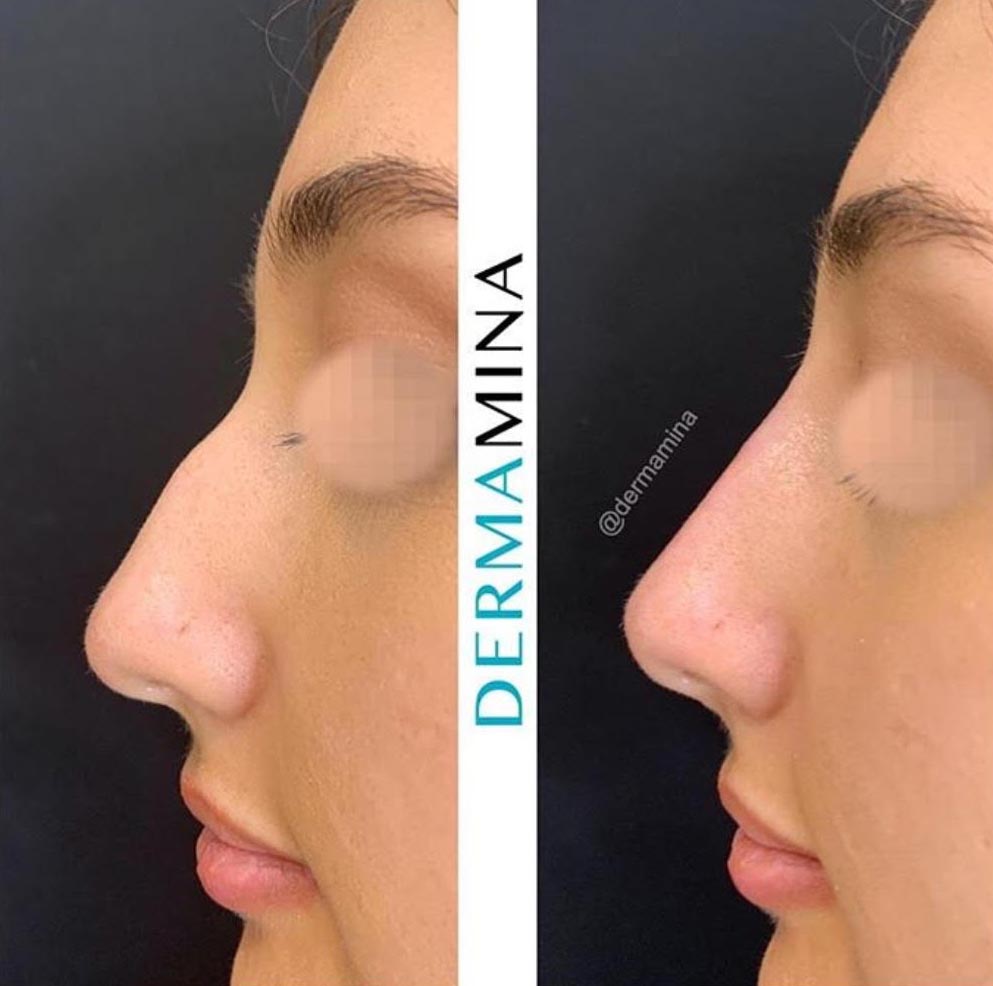 non surgical nose job london