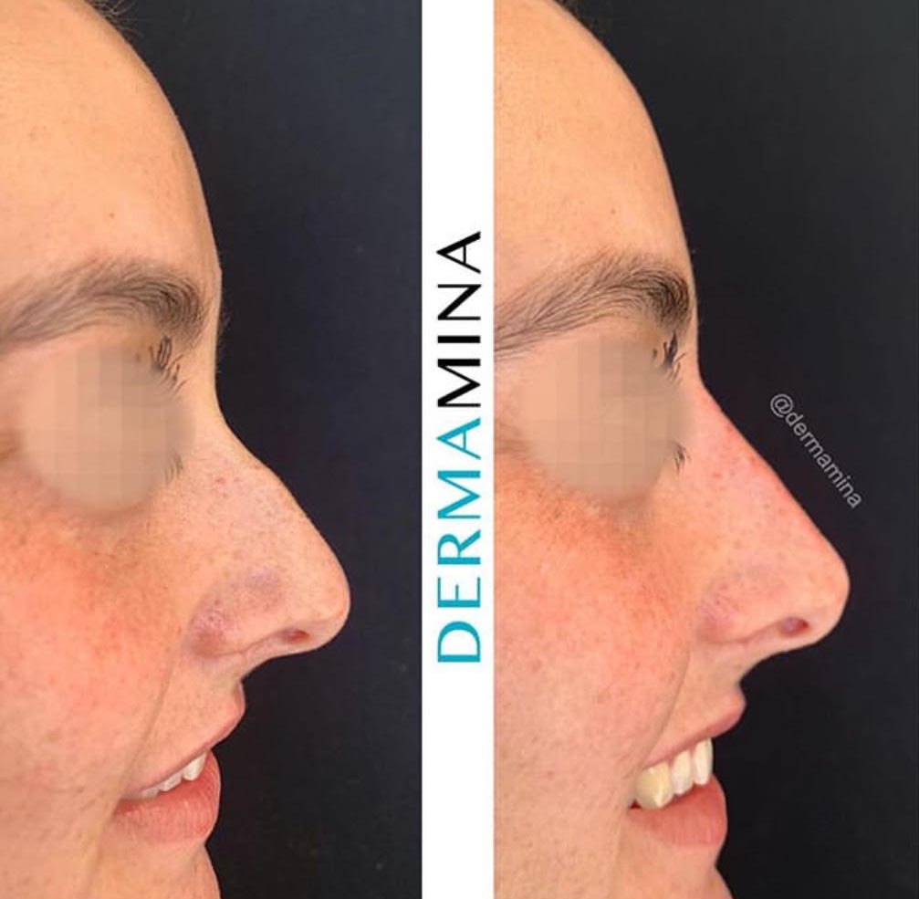 Non Surgical Nose Job London