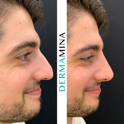 Non Surgical Nose Job London