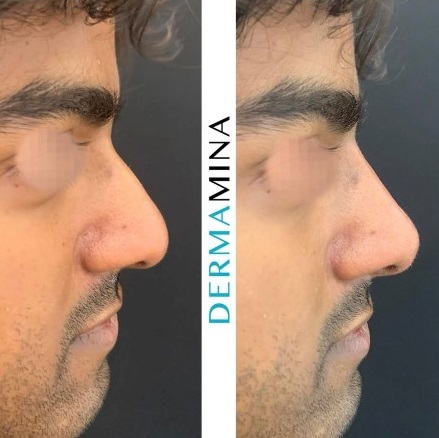 Non Surgical Nose Job London