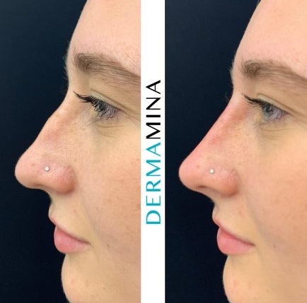 Non Surgical Nose Job London