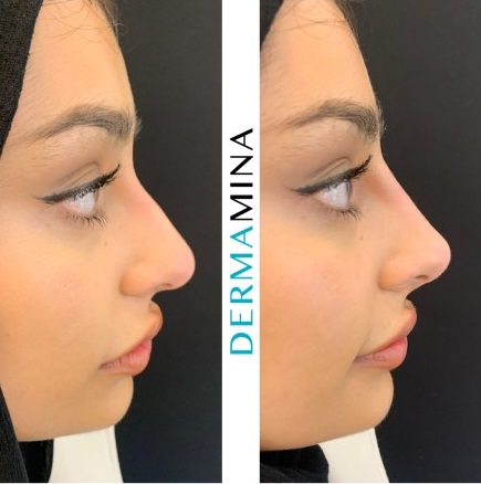 Non Surgical Nose Job London