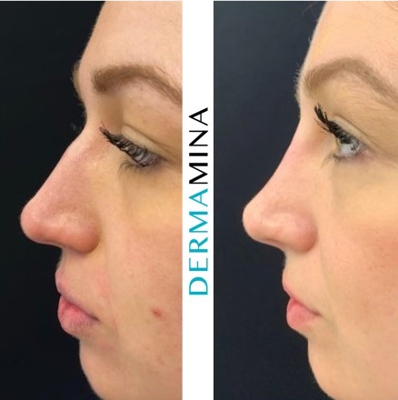 Non Surgical Nose Job London