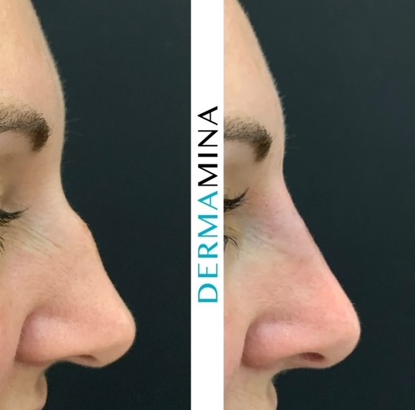 Non Surgical Nose Job London