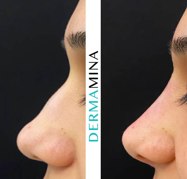 Nose Filler before and after