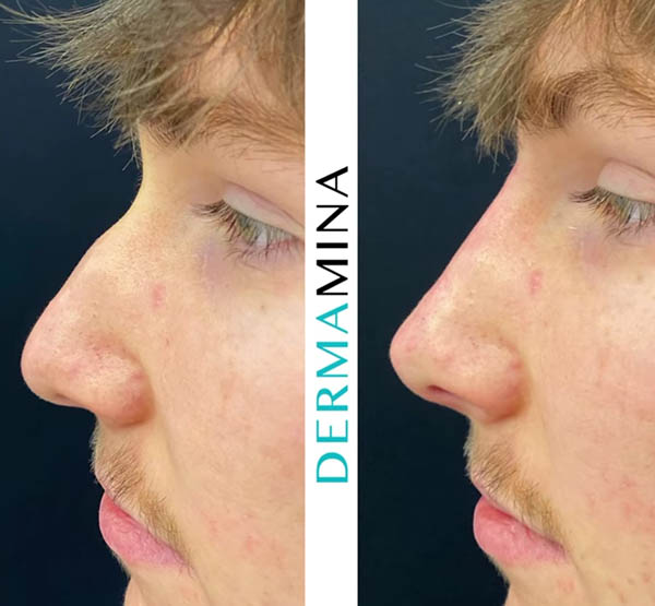 Liquid Nose Job before and after