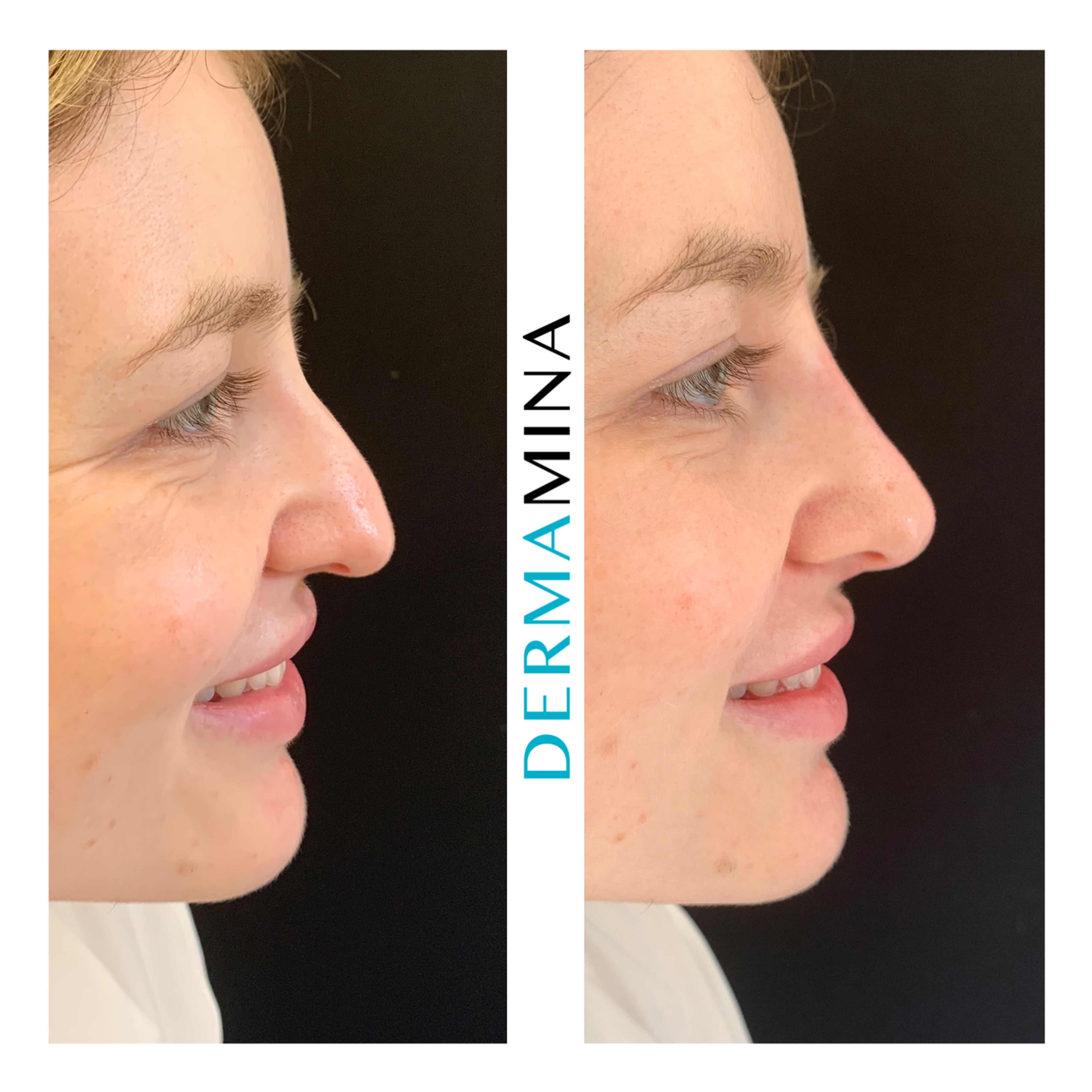 Non Surgical Nose Job London