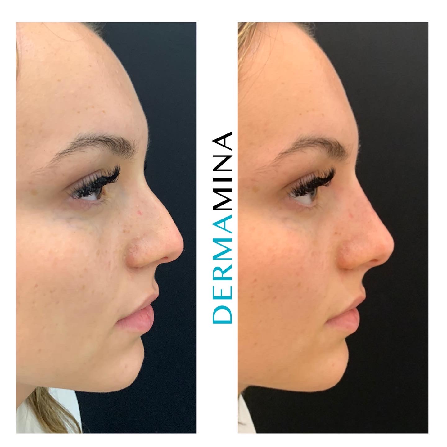 Non Surgical Nose Job London