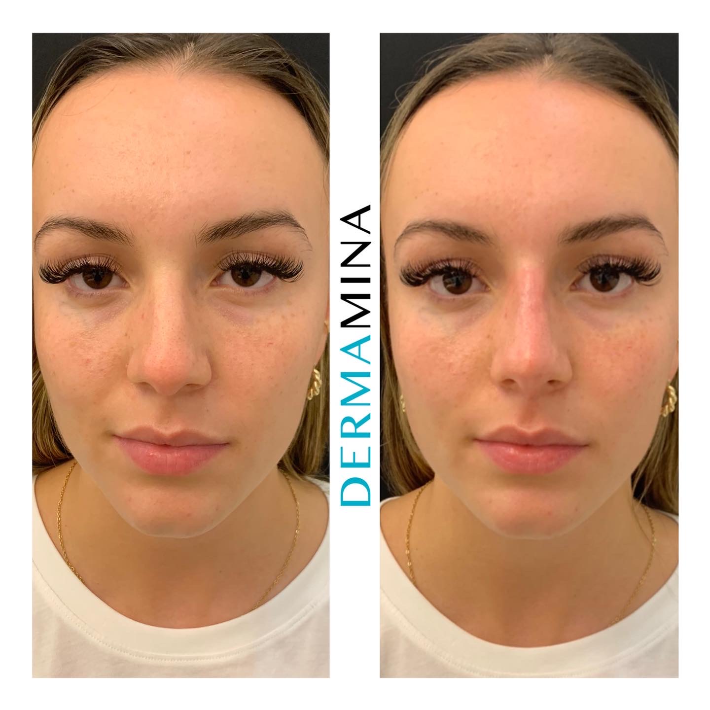 Non Surgical Nose Job London