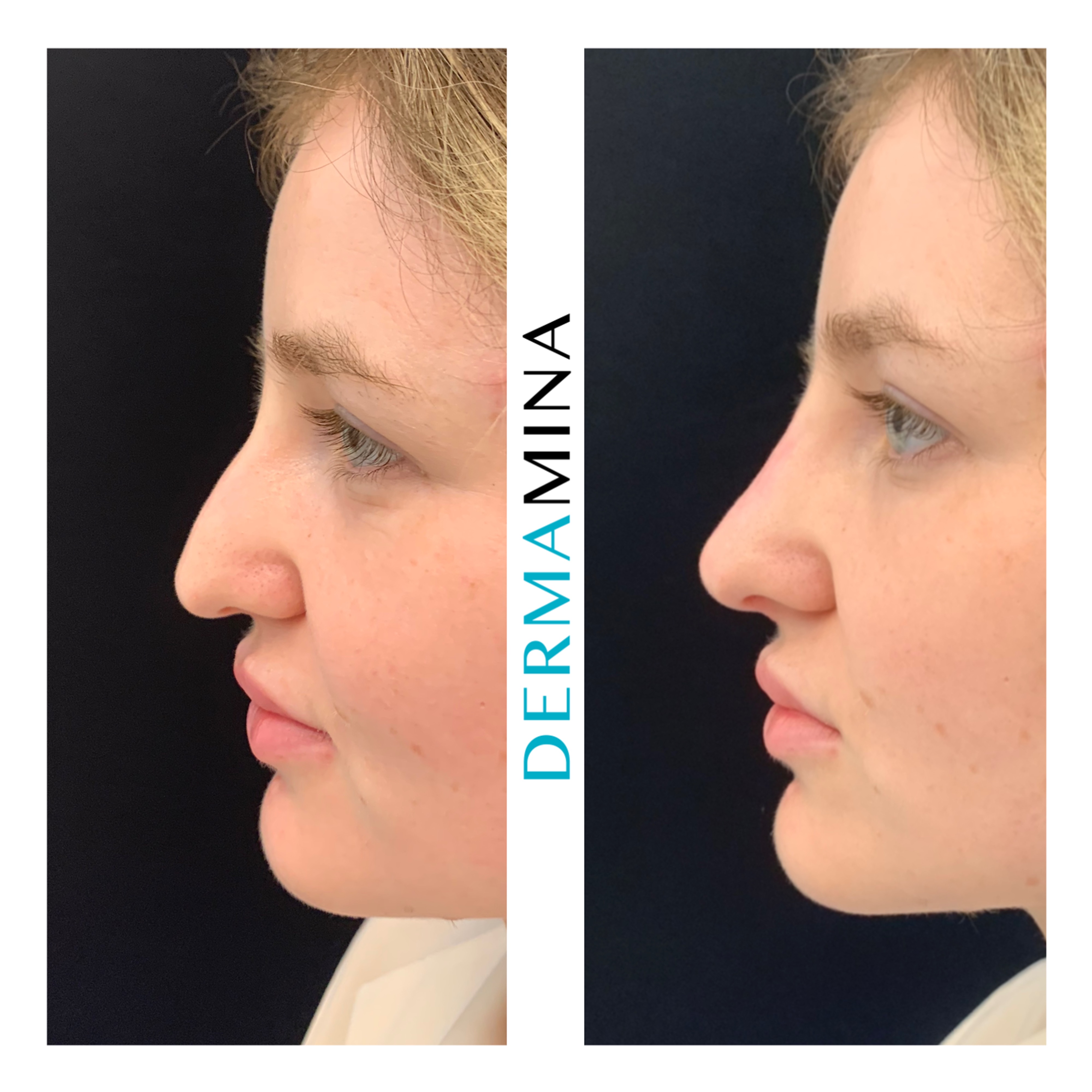 Non Surgical Nose Job London