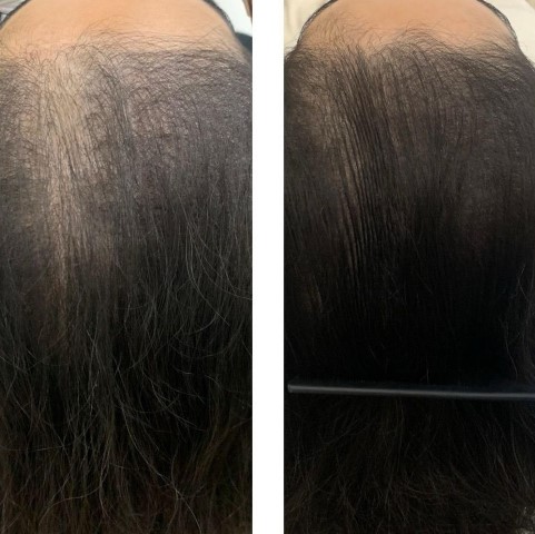 Hair Loss Before and After