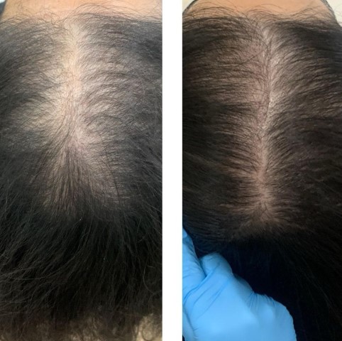 Hair Loss Treatment Before and After