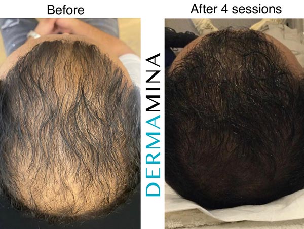 PRP Hair Restoration · Dermamina