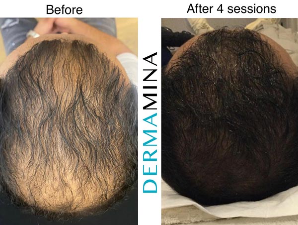 prp hair restoration before and after