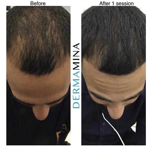 Hair Loss Treatment Before and After