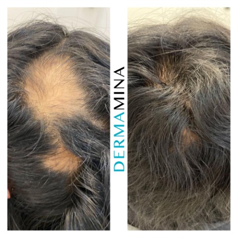 prp hair restoration before and after