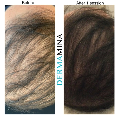 Hair Loss Treatment Before and After